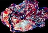 tumor_small.jpg (12123 bytes)